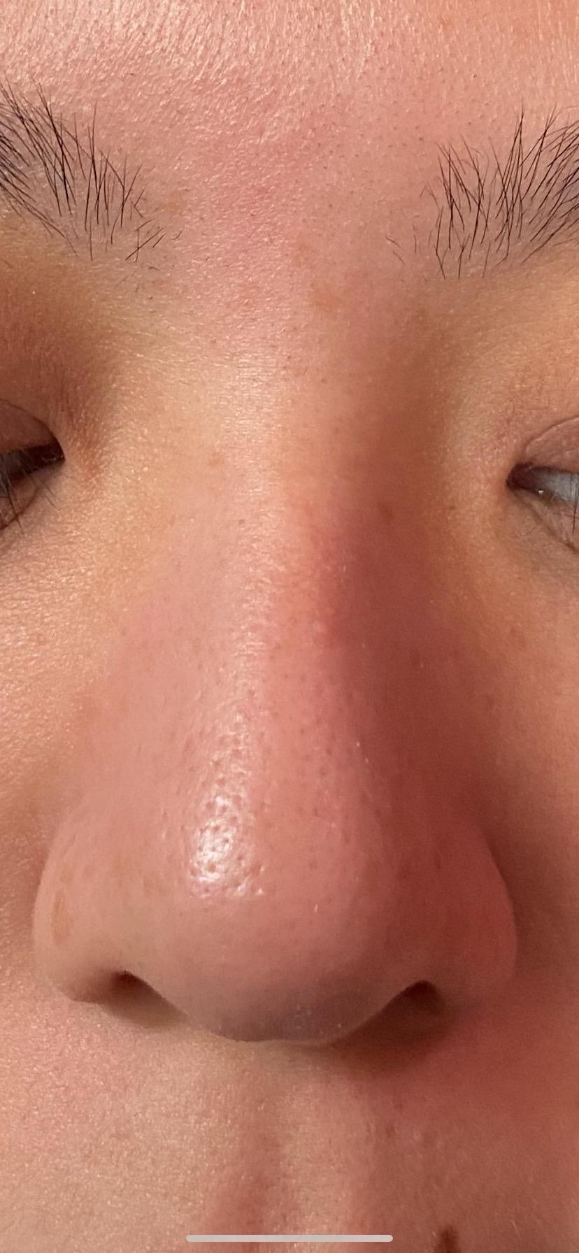 VOYOR Blackhead Remover Pore Vacuum - Electric Face Vacuum Pore Cleaner Acne White Heads Removal with 6 Suction Heads (BR410) customer photo 1