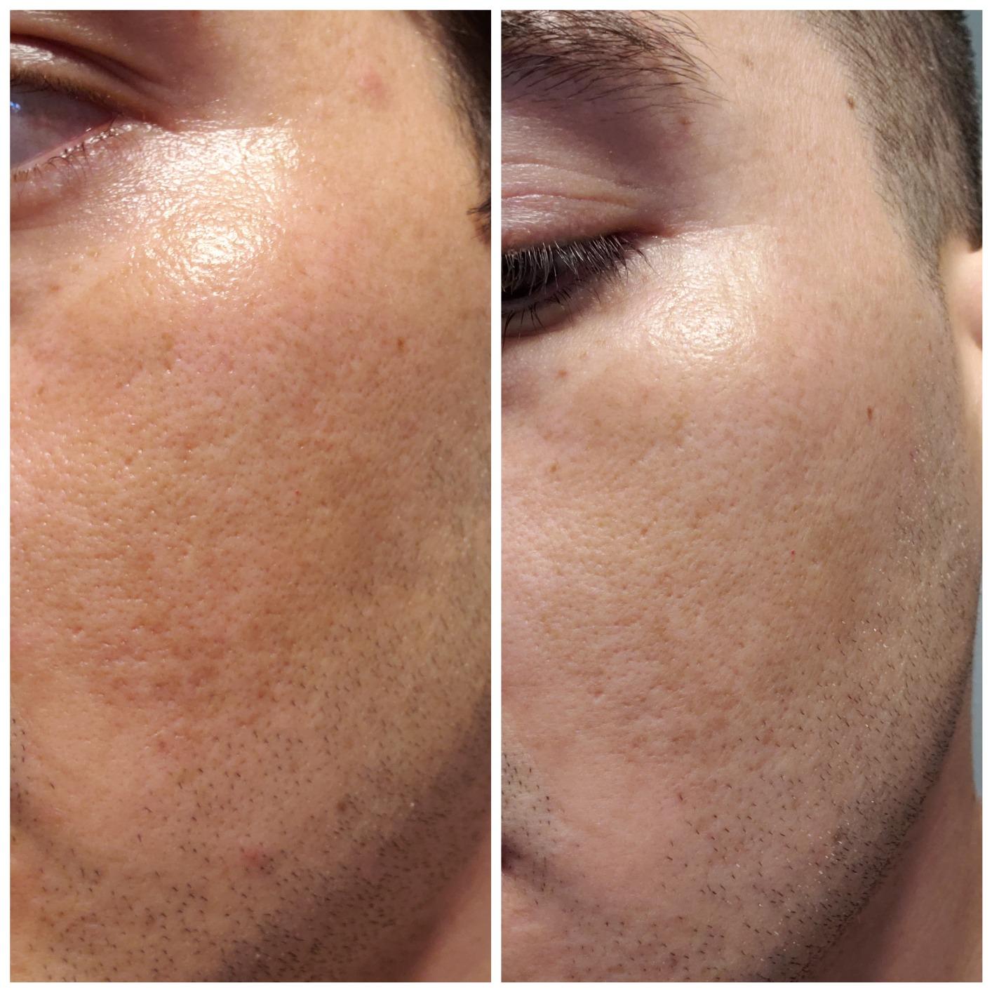 Derma Roller Microneedle 6 Piece Kit [DERMAROLL by Prosper Beauty] Face Roller with 4 Replaceable Heads Exfoliation Microdermabrasion Micro Derma Skin Care Tool Dermaplaning Microneedling customer photo 1