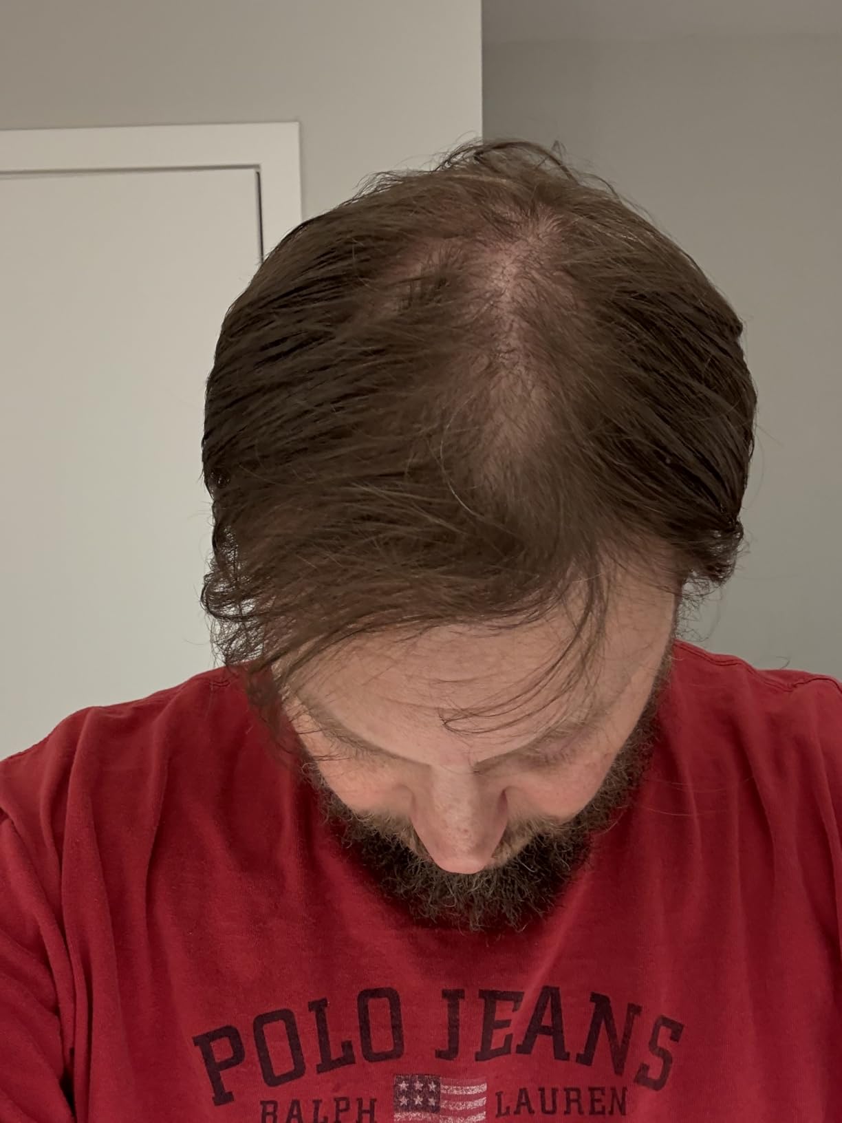 EVO Laser Hair Growth Helmet LH40 - 100% Laser, No Ineffective LEDs - FDA-Cleared Red Light Therapy for Hair Regrowth 4x Week - Made in the USA customer photo 2