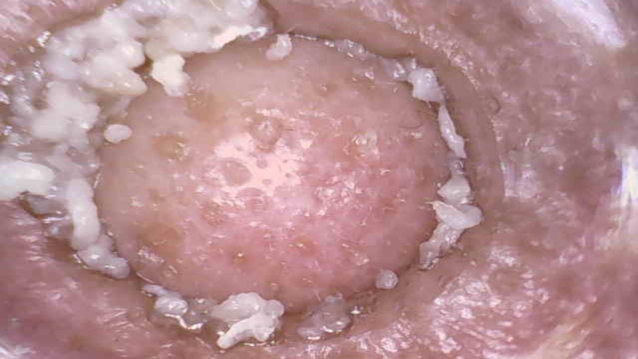 Blackhead Remover Pore Vacuum with 5MP HD Camera, 20X Magnification WiFi Visible Facial Pore Cleanser, FDA-Registered Electric Pimple Acne Comedone Extractor Kit for Men & Women with 6 Probes customer photo 1