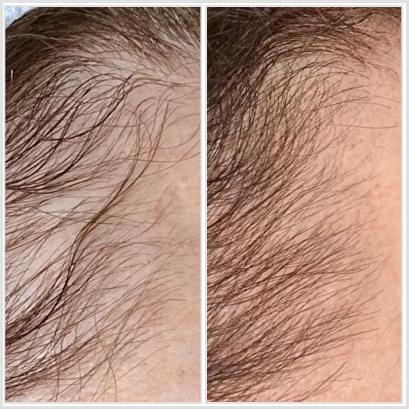 Hairmax LaserBand 82 Hair Growth and Regrowth Treatment - Home-Use Medical Device with Medical Grade Lasers customer photo 1