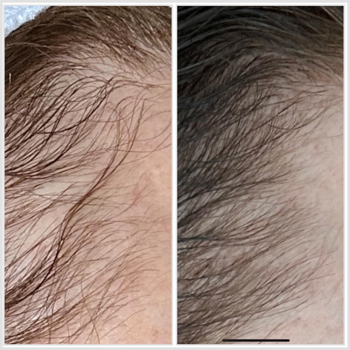 Hairmax LaserBand 82 Hair Growth and Regrowth Treatment - Home-Use Medical Device with Medical Grade Lasers customer photo 2