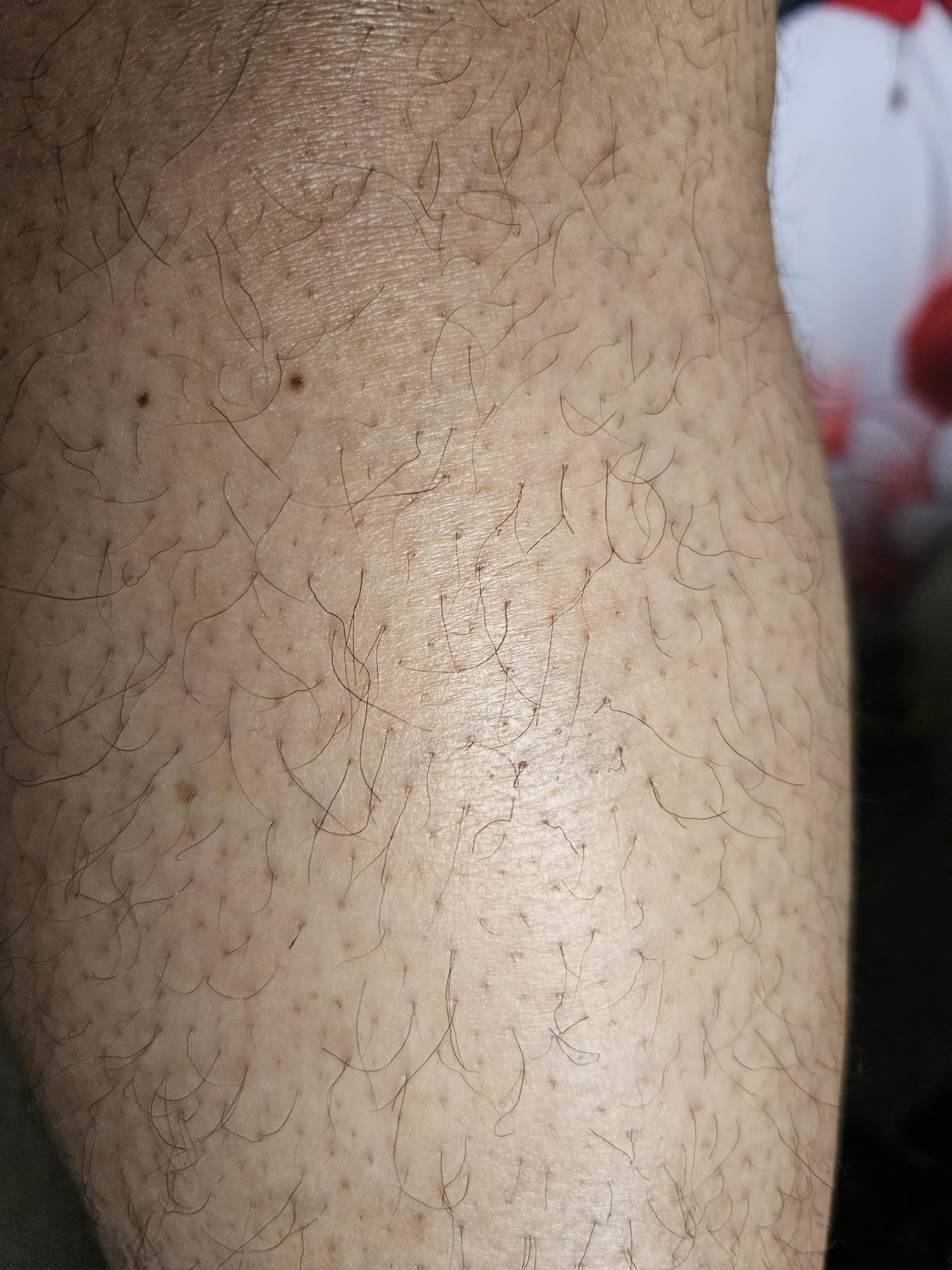 Ulike Laser Hair Removal Device Air 10 IPL - Ice Cool Permanent Hair Reduction, Dual Lights, Skin Sensor & USHR Mode, 10 Min Sessions from Home customer photo 1