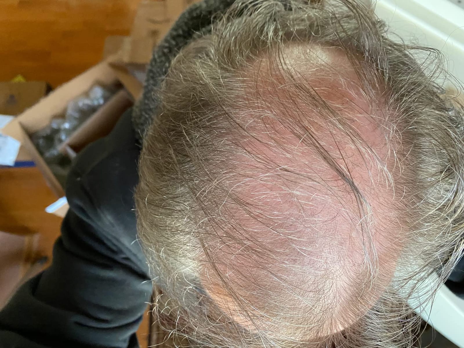 Theradome PRO Laser Hair Growth Helmet LH80 - 100% Laser, No Ineffective LEDs - FDA-Cleared Red Light Therapy for Hair Regrowth 2x Week - Made in USA customer photo 1