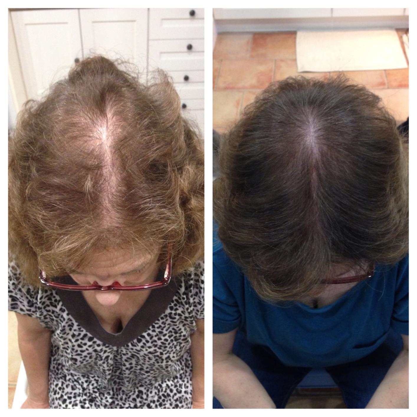 Theradome PRO Laser Hair Growth Helmet LH80 - 100% Laser, No Ineffective LEDs - FDA-Cleared Red Light Therapy for Hair Regrowth 2x Week - Made in USA customer photo 2