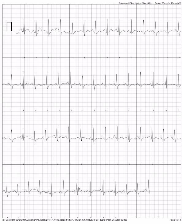 KardiaMobile 1-Lead EKG Monitor, Medical-Grade FDA-Cleared Personal Heart Monitor, Detects Normal, AFib & Arrhythmias, 30 Second Results, Works with Most Smartphones, HSA&FSA Eligible customer photo 1