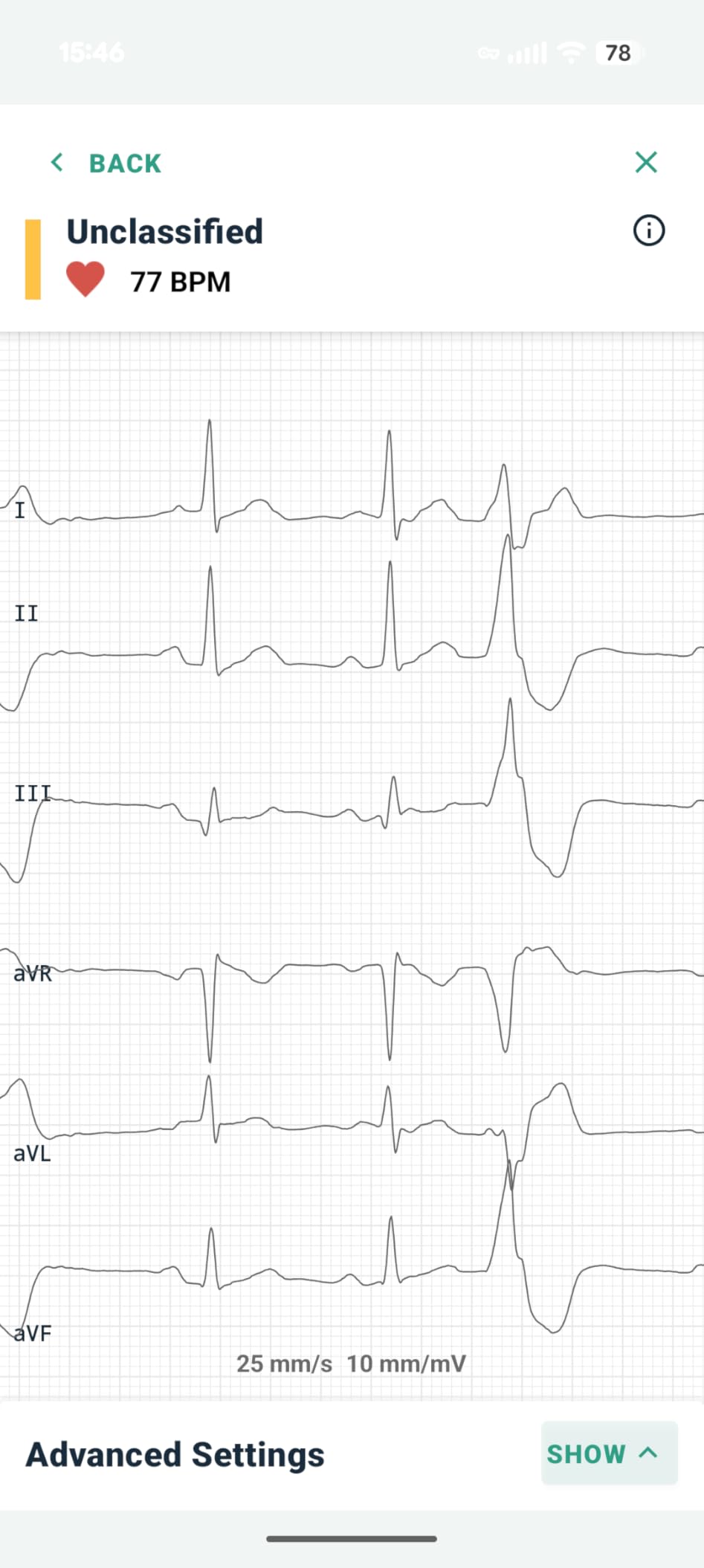 KardiaMobile 6-Lead Personal EKG Monitor - Six Views of The Heart - Detects AFib and Irregular Arrhythmias - Instant Results in 30 Seconds - Works with Most Smartphones - FSA/HSA Eligible customer photo 2