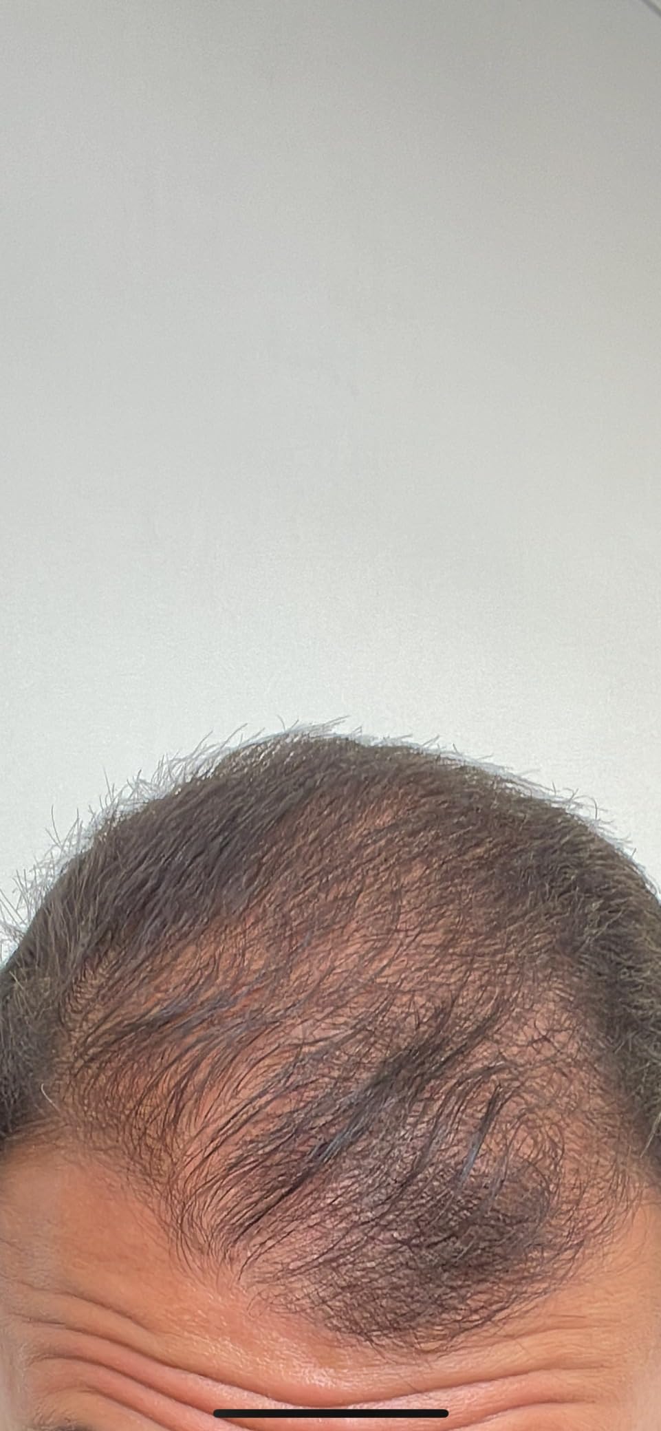 Hairmax PowerFlex 272 FDA Cleared Hair Regrowth Laser Red Light Therapy Cap - 100% Medical Grade Lasers customer photo 1
